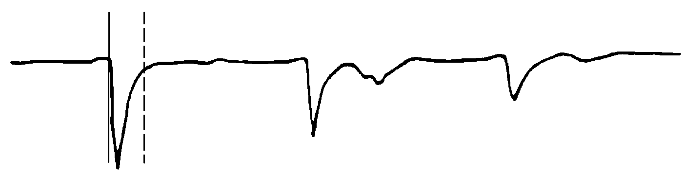 遠(yuǎn)端故障線芯與良好線芯不連接的波形 遠(yuǎn)端故障線芯與良好線芯不連接的波形